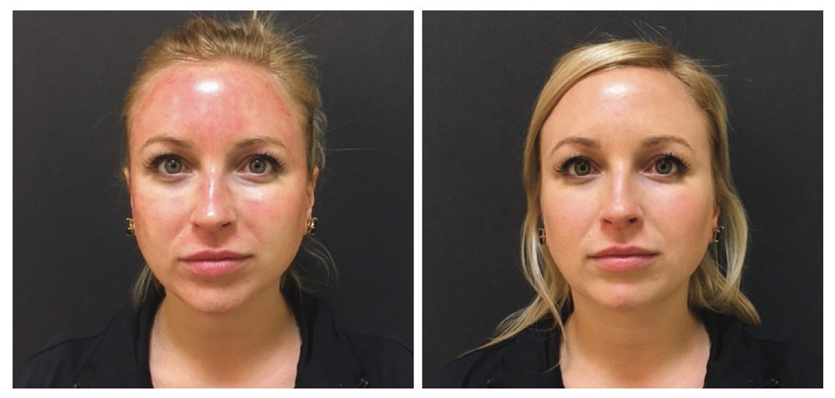 Micro Needling eine sanfte Behandlung vorher nachher Ayla Kosmetik Düsseldorf